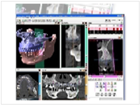 インプラントCG写真3D