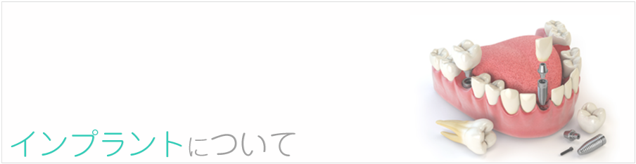 インプラントについて