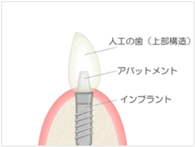 インプラントアパットメント